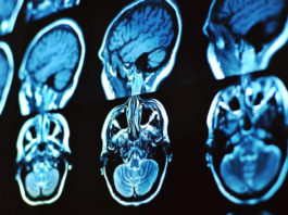 ¿Qué le pasa a tu cerebro cuando tienes una crisis? crisis de cerebro cuando hay estres