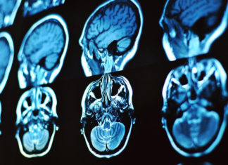 ¿Qué le pasa a tu cerebro cuando tienes una crisis? crisis de cerebro cuando hay estres