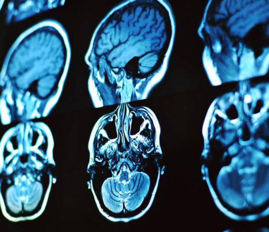 ¿Qué le pasa a tu cerebro cuando tienes una crisis? crisis de cerebro cuando hay estres