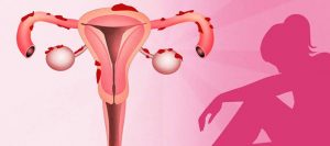 Razones por las que arrojas coágulos menstruales
