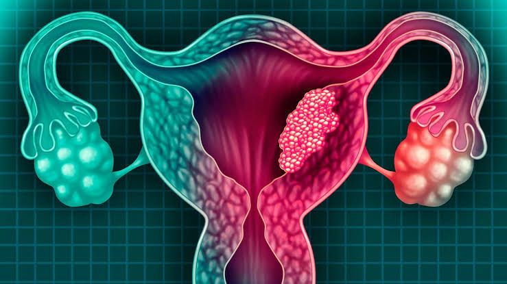 Síntomas que alertan sobre cáncer de cuello uterino