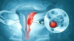 Síntomas que alertan sobre cáncer de cuello uterino