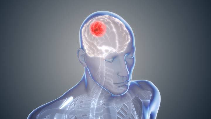 Qué es el glioblastoma, sus síntomas y tratamiento