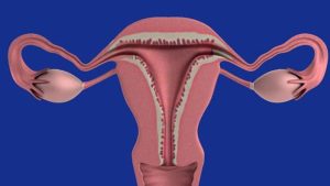 ¿Qué es la Adenomiosis uterina