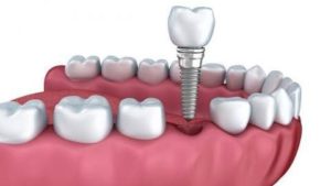 Mitos que debes saber sobre el Implante dental