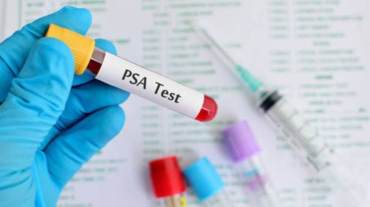 ¿Qué significa el PSA (antígeno prostático específico)