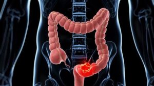 Cáncer de colon 7 síntomas para detectarlo