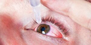 Causas y remedios para los ojos rojos