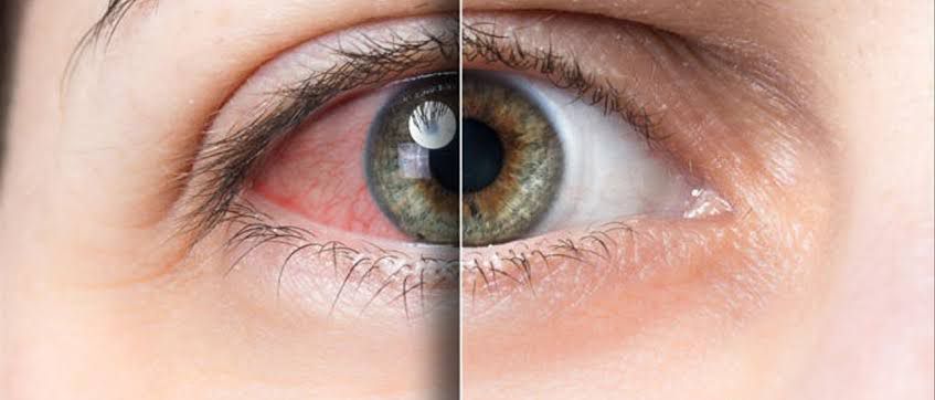 Hipertensión ocular: qué es, síntomas y tratamiento