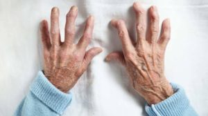 ¿Hay cura para la artritis reumatoide