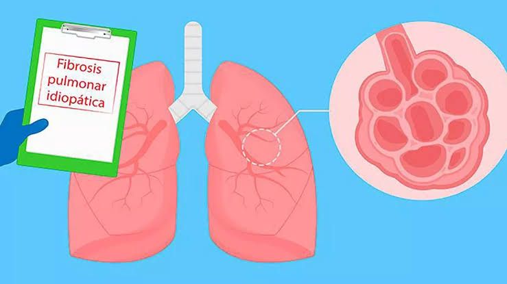 Fibrosis quística ¿qué es