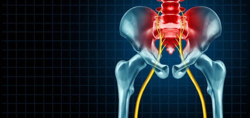 Cómo reducir el dolor del nervio ciático