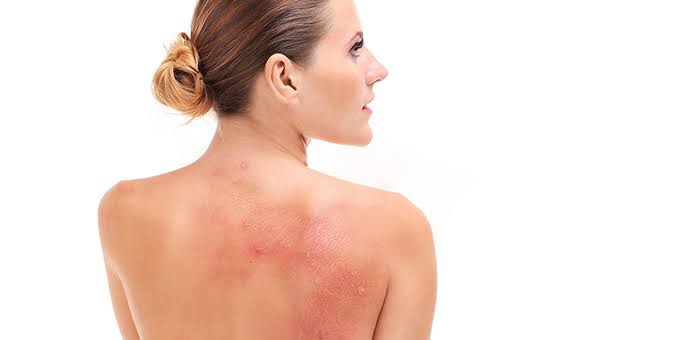 Urticaria que saber de esta enfermedad