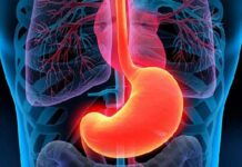 Gastritis erosiva: síntomas y causas Gastritis erosiva síntomas y causas