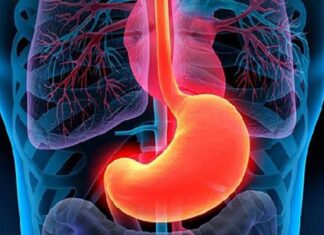 Gastritis erosiva: síntomas y causas Gastritis erosiva síntomas y causas