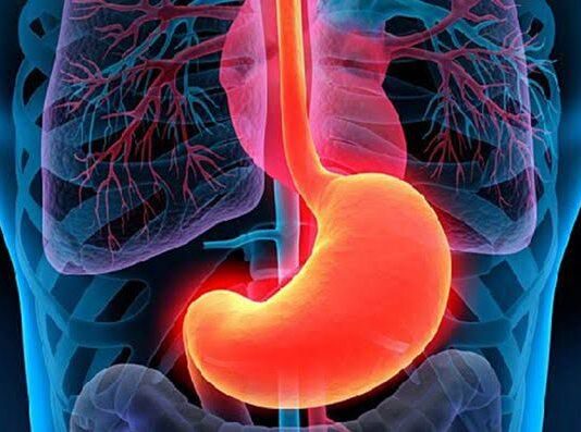 Gastritis erosiva: síntomas y causas Gastritis erosiva síntomas y causas