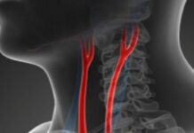 ¿Enfermedad de las arterias carótidas? ¿Enfermedad de las arterias carótidas