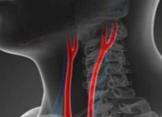 ¿Enfermedad de las arterias carótidas? ¿Enfermedad de las arterias carótidas