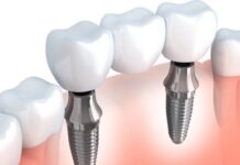 Puente dental: tipos, beneficios y desventajas Puente dental tipos, beneficios y desventajas