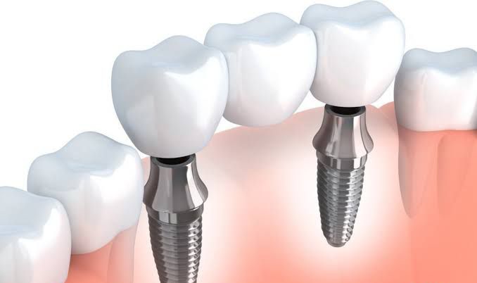 Puente dental tipos, beneficios y desventajas