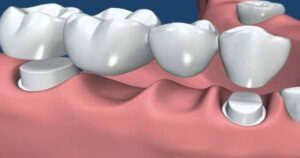 Puente dental tipos, beneficios y desventajas