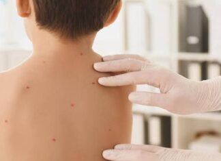 Varicela (para padres) Varicela (para padres)