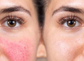 ¿Padeces rosácea? cosas que debes evitar ¿Padeces rosácea cosas que debes evitar