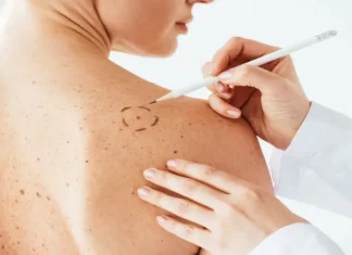 Lunares, ¿Son buenos o malos? Lunares-¿Son-buenos-o-malos