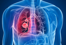 Cáncer de Pulmón, el segundo cáncer más común Cancer-de-Pulmon-el-segundo-cancer-mas-comun-