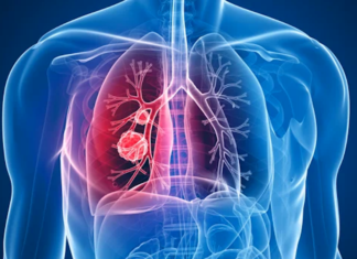 Cáncer de Pulmón, el segundo cáncer más común Cancer-de-Pulmon-el-segundo-cancer-mas-comun-