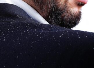 Tipos de caspa, ¿por qué salen? Caspa-¿por-que-sale