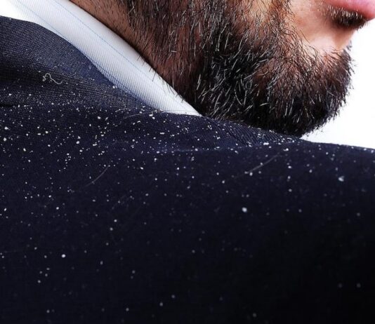 Tipos de caspa, ¿por qué salen? Caspa-¿por-que-sale