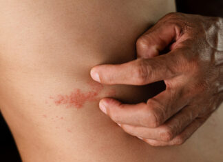 Herpes zóster, reactivación del virus de la varicela Herpes-zoster-reactivacion-del-virus-de-la-varicela-scaled.