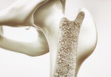 Osteoporosis, ¿qué es? Osteoporosis-¿que-es