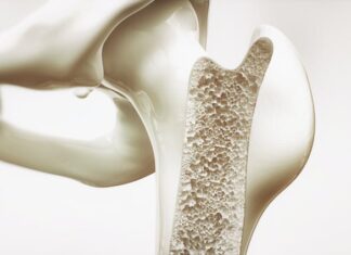 Osteoporosis, ¿qué es? Osteoporosis-¿que-es