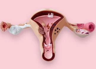 Miomas, el tumor benigno más frecuente en la mujer