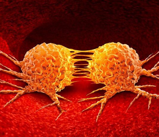 Metástasis, ¿Cómo se clasifica? Metastasis-¿Como-se-clasifica