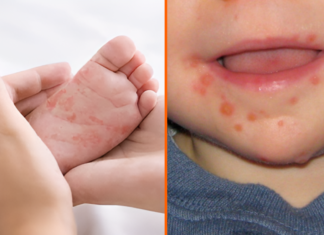 Virus Coxsackie presente en Hidalgo y Puebla Virus Coxsackie presente en Hidalgo y Puebla