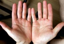 ¿Tienes callos en las manos por tus entrenamientos? callos en las manos