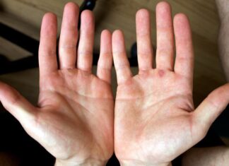 ¿Tienes callos en las manos por tus entrenamientos? callos en las manos