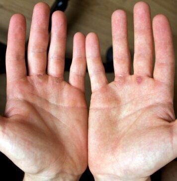 ¿Tienes callos en las manos por tus entrenamientos? callos en las manos