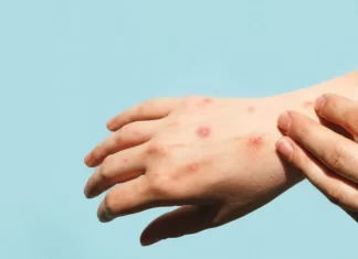 OMS advierte sobre la transmisión del mpox