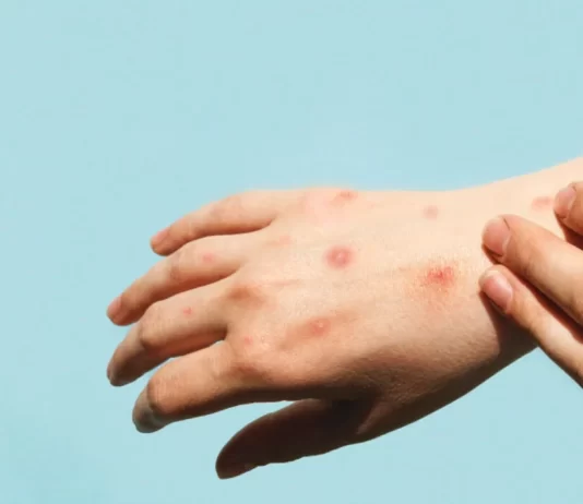 OMS advierte sobre la transmisión del mpox