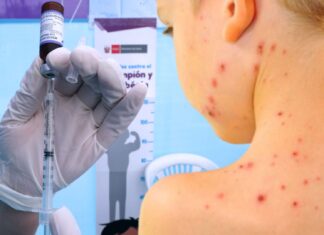 Alerta en América: Casos de sarampión aumentan cinco veces en 2025 Alerta en América Casos de sarampión aumentan cinco veces en 2025