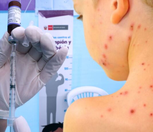 Alerta en América: Casos de sarampión aumentan cinco veces en 2025 Alerta en América Casos de sarampión aumentan cinco veces en 2025