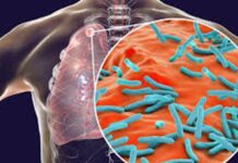 Veracruz es el estado con más casos de tuberculosis en el país Veracruz es el estado con más casos de tuberculosis en el país
