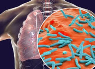 Veracruz es el estado con más casos de tuberculosis en el país Veracruz es el estado con más casos de tuberculosis en el país