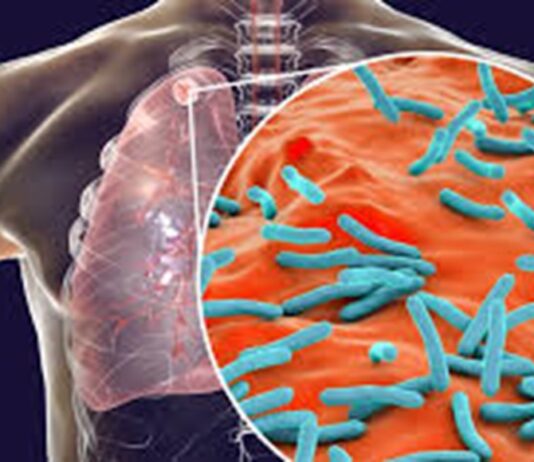 Veracruz es el estado con más casos de tuberculosis en el país Veracruz es el estado con más casos de tuberculosis en el país