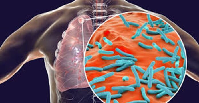 Veracruz es el estado con más casos de tuberculosis en el país Veracruz es el estado con más casos de tuberculosis en el país