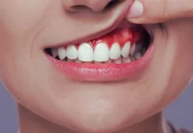 ¿Gingivitis o encías sensibles? Guía para diferenciarlas y cuidarlas gingivitis o encias sensibles